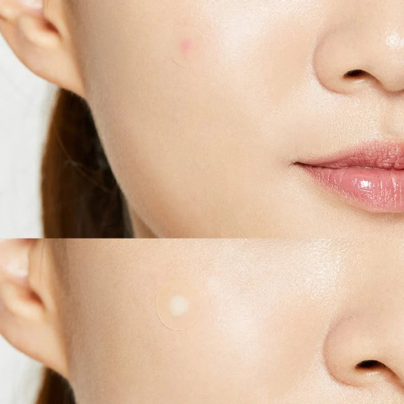 COSRX Acne Pimple Master Patches