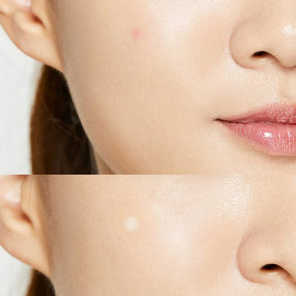 COSRX Acne Pimple Master Patches